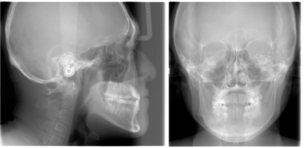 頭部規格X線写真