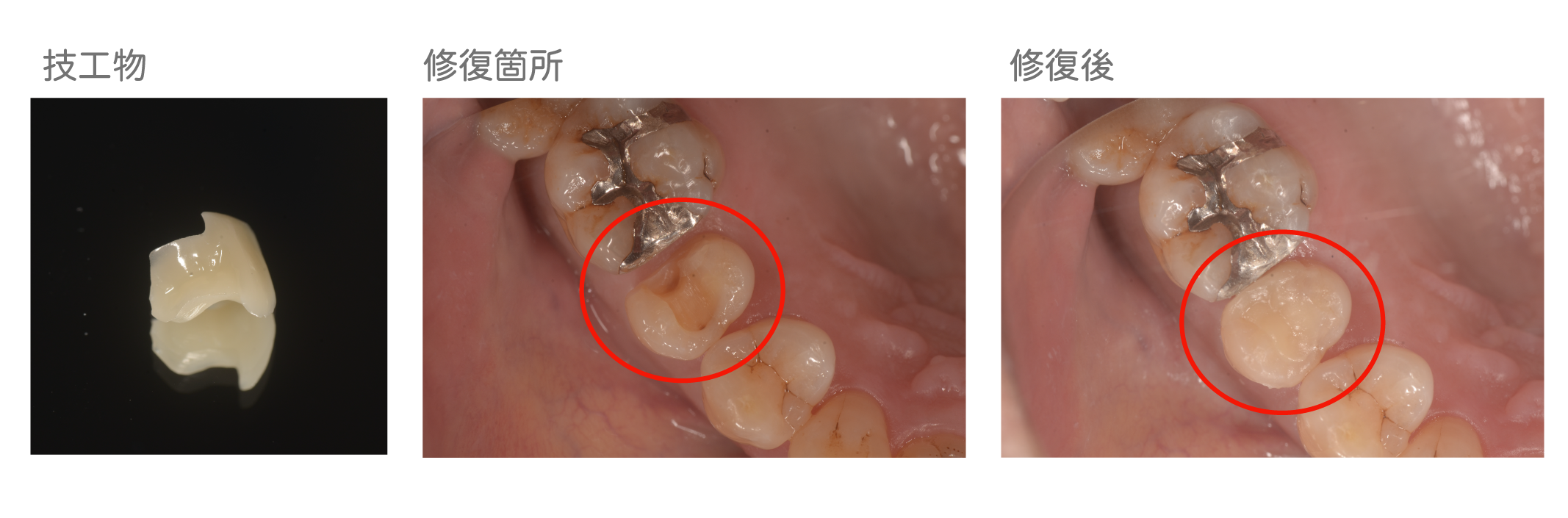 保険適用ハイブリッドセラミックの詰め物