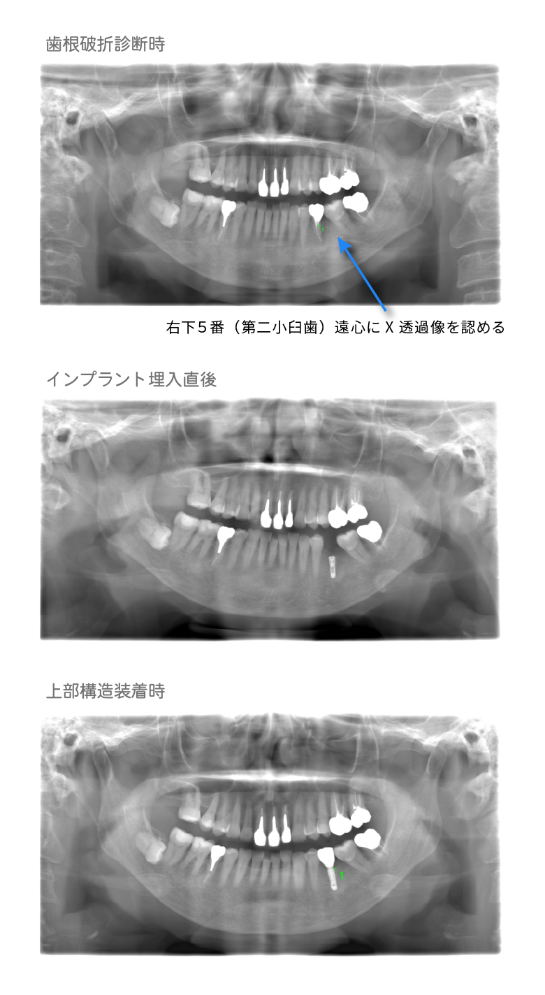 歯根破折診断時・インプラント埋入直後・上部構造装着時①