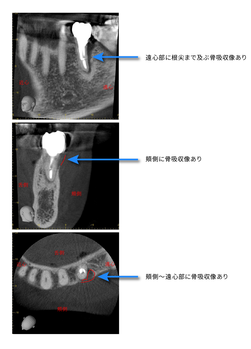 歯根破折診断時・インプラント埋入直後・上部構造装着時②