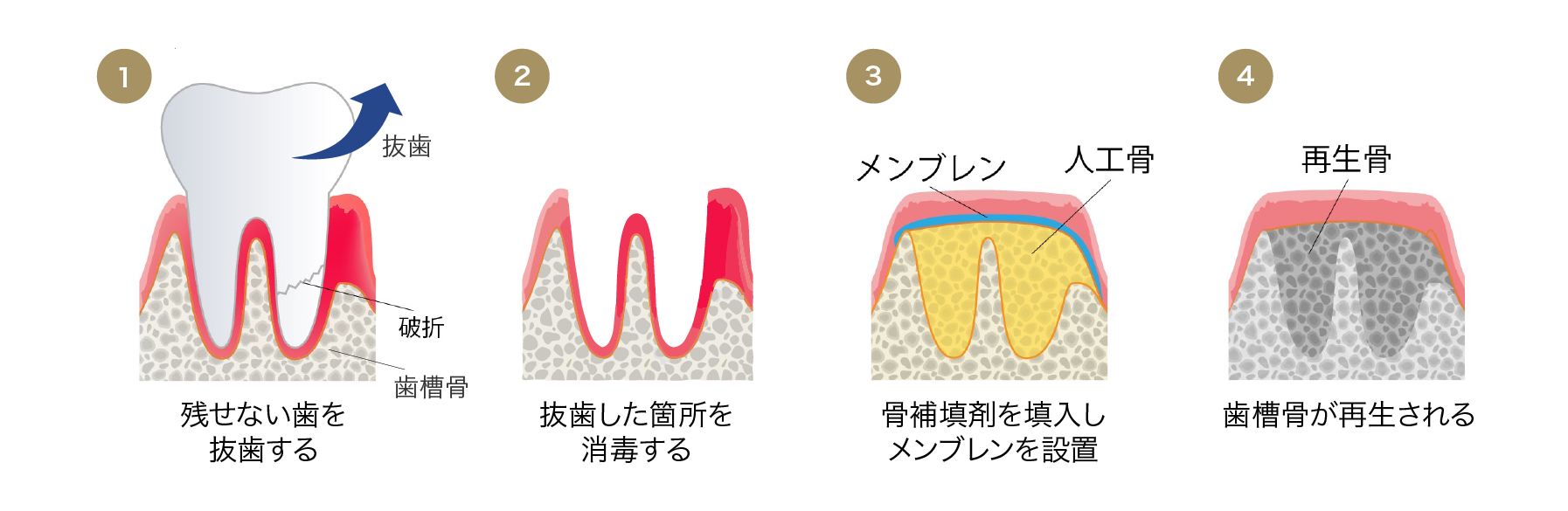 図説：ソケットプリザベーション