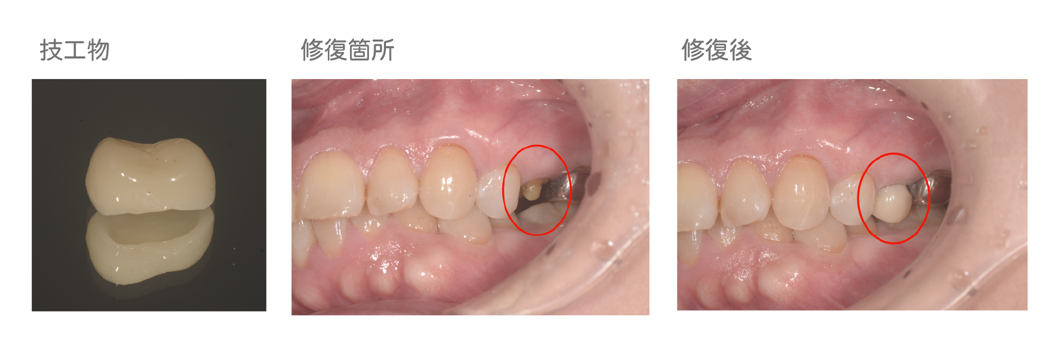 保険適用ハイブリッドセラミックの被せ物