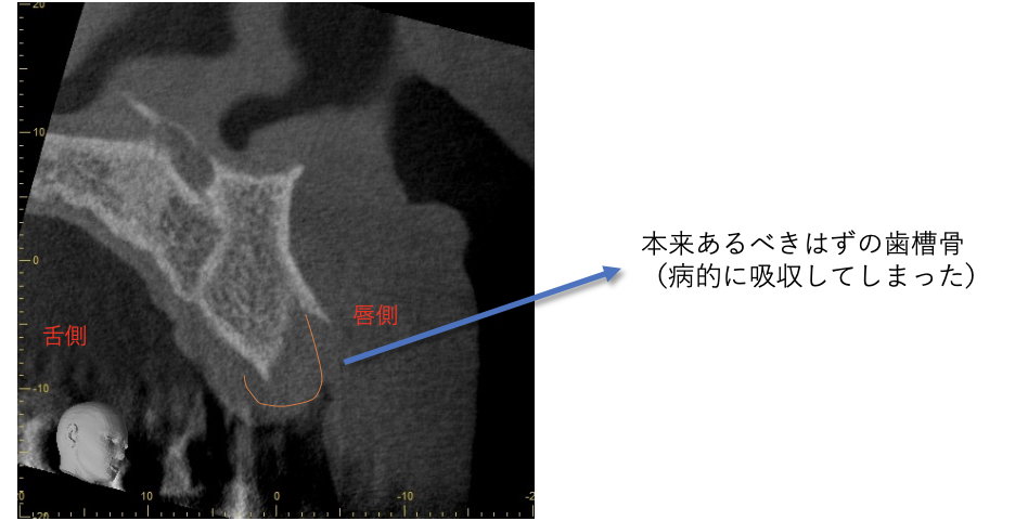 術前CT像