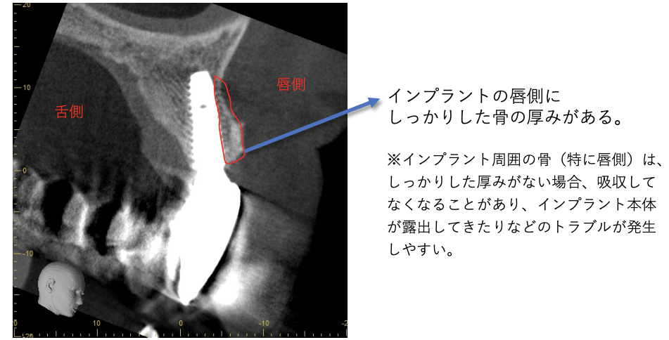 インプラント、上部構造セット後6ヶ月経過時 CT像