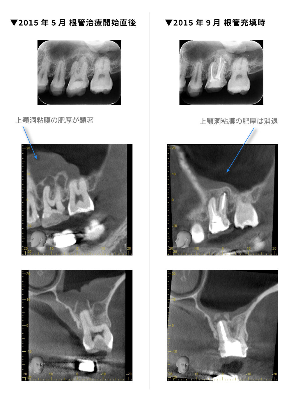 2015年5月根管治療開始直後から2015年9月根管充填時