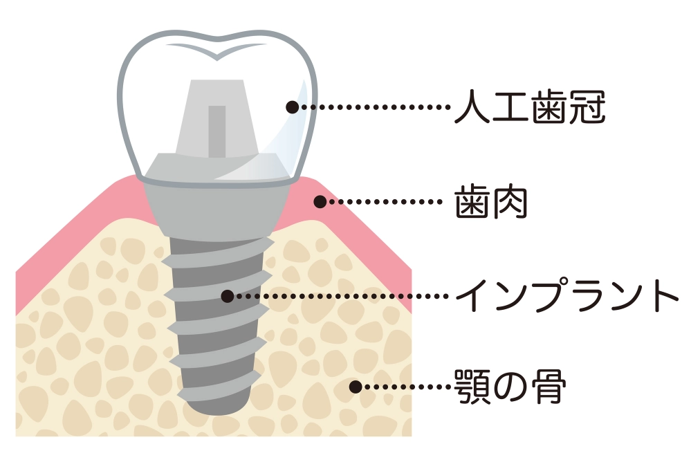 インプラント説明図