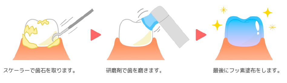 PMTC・歯のクリーニング