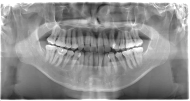 歯科用パノラマX線写真